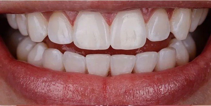 After – Gap Closure