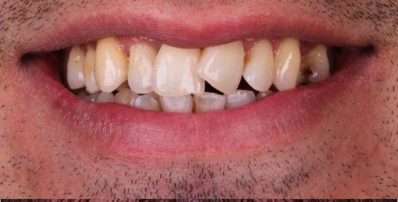 Before – Bite Alignment