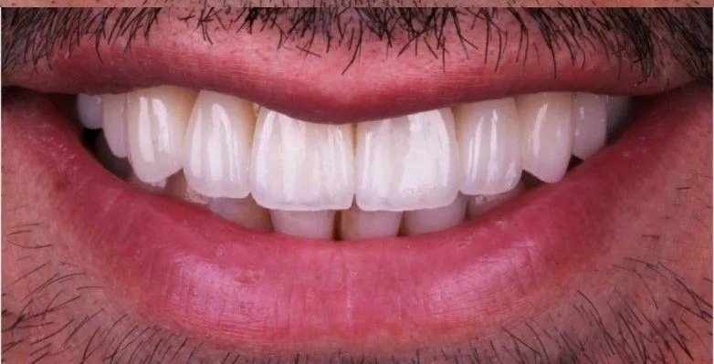 After – Bite Alignment