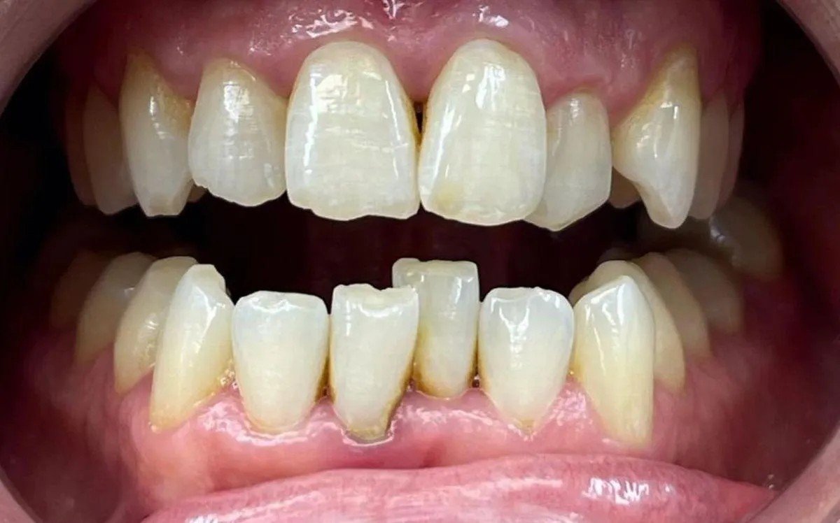 Before – Invisalign Alignment