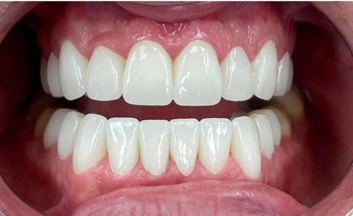 After – Invisalign Alignment